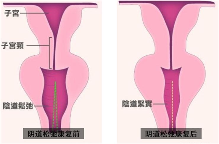 【盆底肌修復(fù)】盆底不修復(fù)，老來(lái)后患無(wú)窮