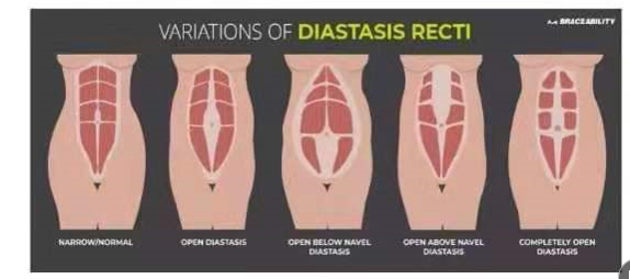 腹直肌分離如何分類？腹直肌分離修復(fù)