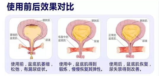 盆底康復(fù)治療怎么做？產(chǎn)后盆底功能檢測(cè)很重要