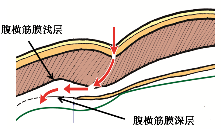 產(chǎn)后腹直肌分離如何康復(fù)，腹直肌修復(fù)那點(diǎn)事