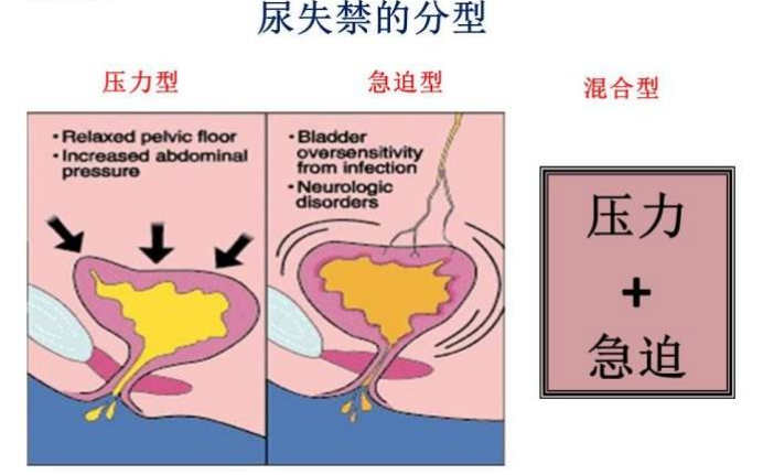 產(chǎn)后盆底肌怎么修復(fù)|尿失禁的類型，傻傻分不清