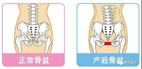 產(chǎn)后康復儀器能對骨盆產(chǎn)生康復鞏固作用嗎？答案肯定是可以的