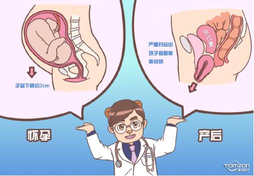 盆底康復治療儀可以解決子宮下降問題嗎？