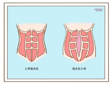 盆底肌修復儀器