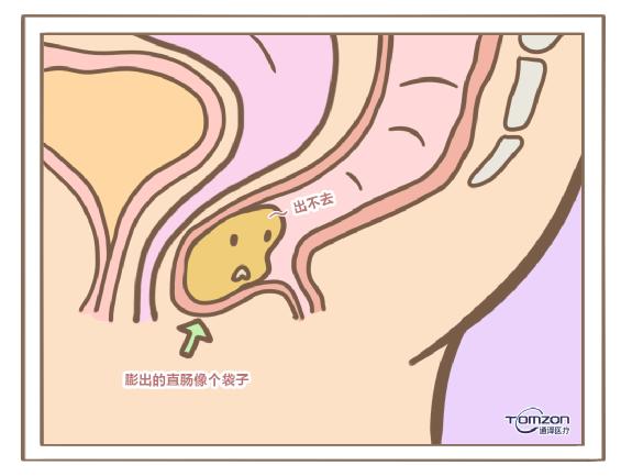 盆底肌修復(fù)儀.jpg